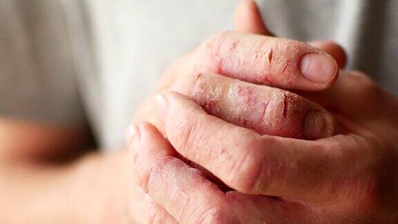 一个患有牛皮癣和湿疹的人的手指皮肤剥落的特写