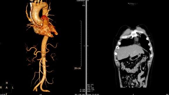 胸主动脉ct血管造影(CTA)三维渲染图像VS冠状面