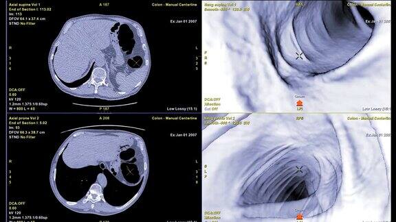 CT结肠镜比较轴向和3D电影文件筛查大肠癌检查结肠癌筛查