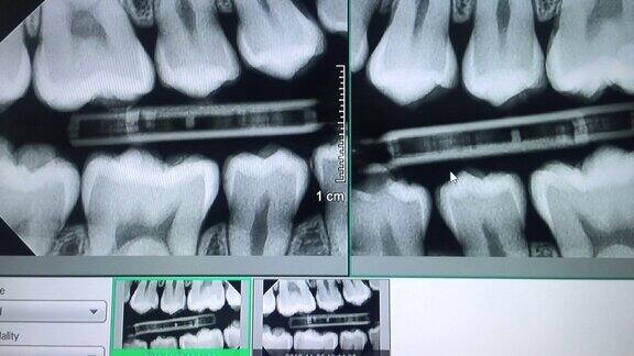 监视器上的牙齿全景x光