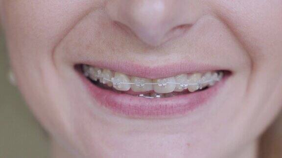 牙齿上的牙套女孩微笑着露出她牙齿上的牙套