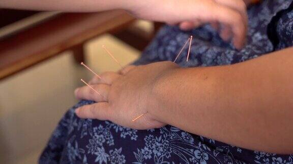 近距离的针灸在一个女人的手上进行