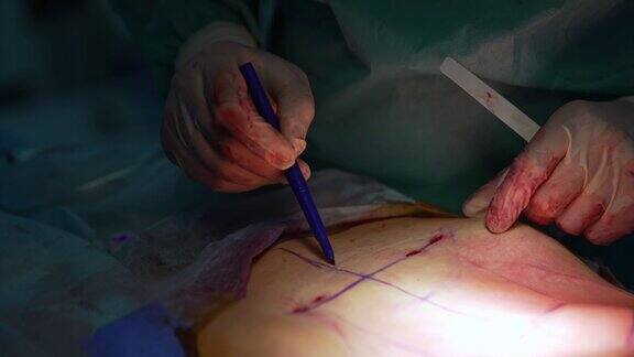 医生用记号笔在病人腹部画线外科医生将有问题的部位标记在腹部以便进一步抽脂特写镜头