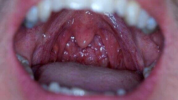 一个张着嘴的男人向医生展示了扁桃体和舌头