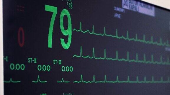 手术中的心脏体征筛选病人的心生命体征监测心电图股票视频