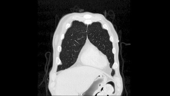 肺部CT扫描