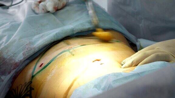 特写镜头在病人的腹部刻有切口腹部表面用碘溶液治疗手术腹部抽脂