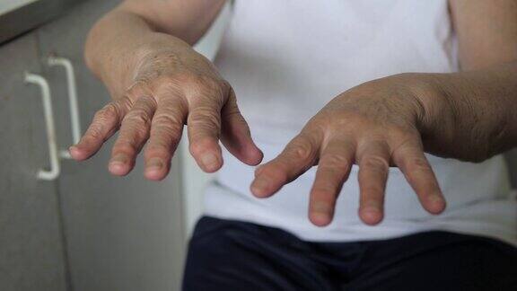 颤抖的手在皱纹的一个老女人与颤抖的疾病的特写