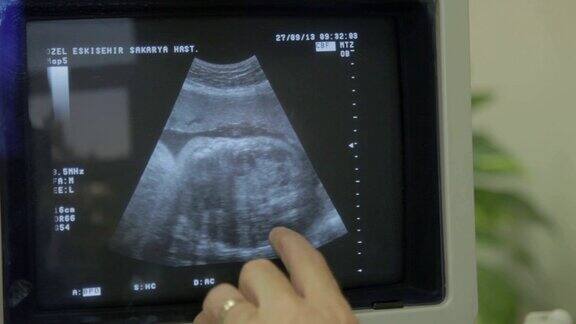 在超声波显示器上人类胚胎正在轻微地移动他的头部