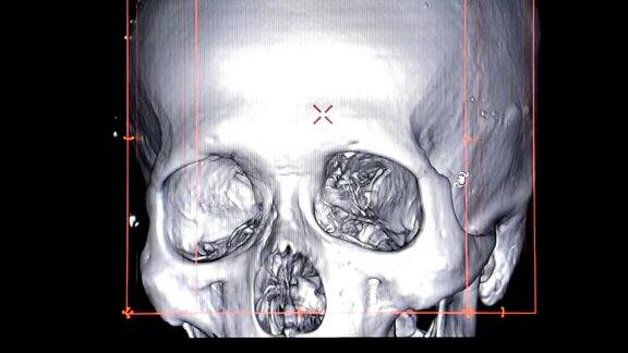 头骨的3d渲染