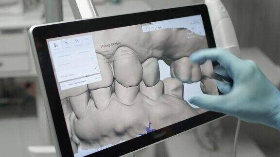 医生在电脑上检查颌骨的3d模型