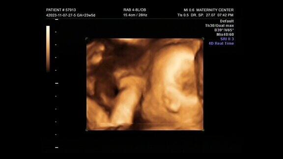 年轻母亲妊娠期人类婴儿胚胎超声3D4D第一个婴儿新生儿在妇产医院的ecograph显示屏上检查