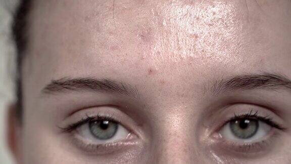 女孩在脸上涂抹治疗霜囊性痤疮
