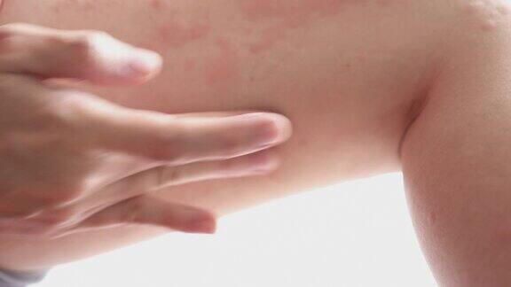 妇女适用于皮疹荨麻疹或过敏的身体