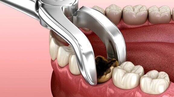 拔除受龋害的臼齿医学上准确的牙齿3D动画