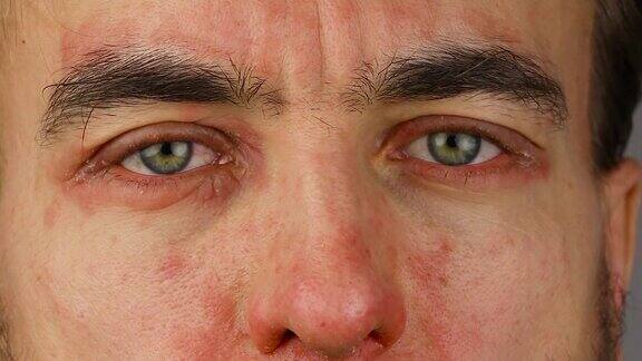 男子双眼发红有过敏反应面部皮肤发红脱皮季节性皮肤病问题特写
