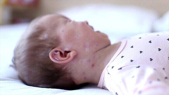哭闹的小女孩得了麻疹