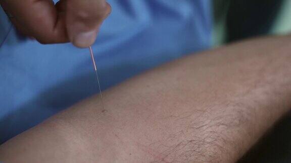 在水疗中心进行针灸治疗时整体治疗师正在从男性手上取下针灸针