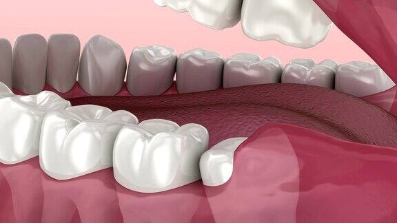 智齿的问题医学上准确的牙齿3D动画