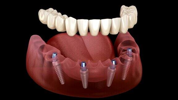下颌假体4个系统种植体支持医学上精确的人类牙齿和假牙的三维动画概念