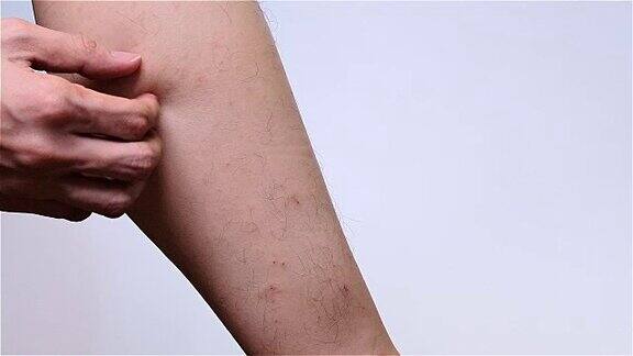 一个男人在他的腿上抓了一个发痒的疹子