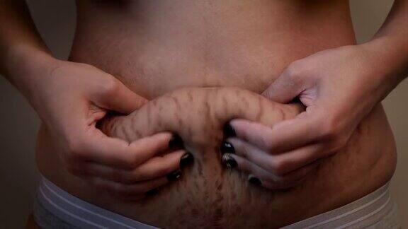 女人腹部皮肤有严重的拉伸皱纹
