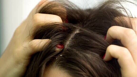一个女人在抓头上有头皮屑的头发