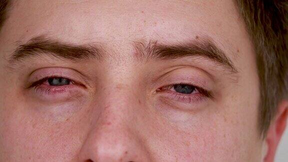 蓝色男性红色眼睛的特写结膜炎眼睛疲劳不适当的眼睛卫生-后果的形式红色毛细血管的角膜