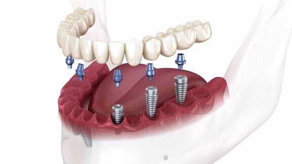 可拆卸的下颌骨假体全部在6系统上由植入物支持医学上精确的人类牙齿和假牙的3D动画