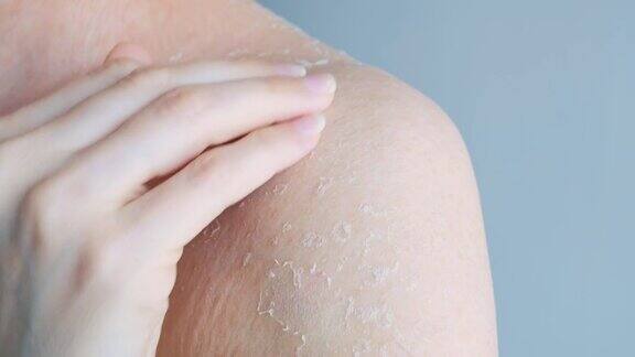 受损皮肤发痒一个女人用指甲抓她的皮肤去除一部分皮肤晒伤后干燥脱落问题皮肤身体保健特写镜头