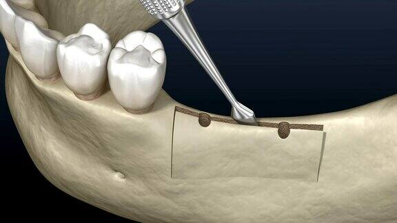 牙槽嵴裂隆胸种植牙科3D动画