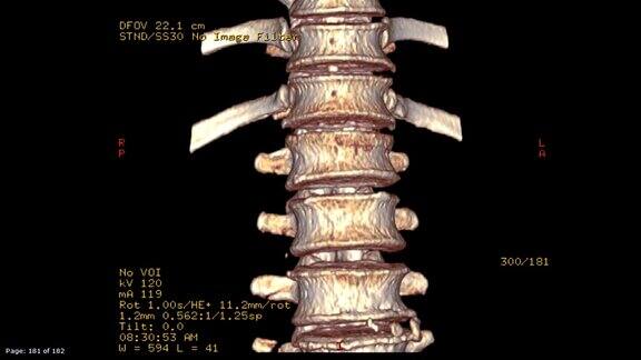 胸腰椎CT扫描图像