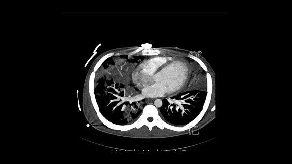轴向平面肺动脉ct诊断肺栓塞