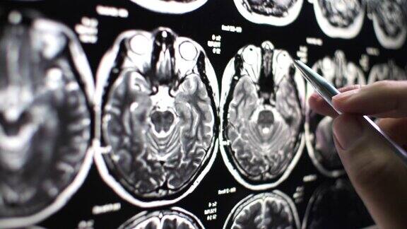 医生检查大脑的核磁共振成像
