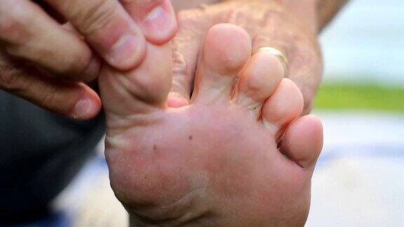 一名男子发现运动员的脚趾长出了发痒的脚