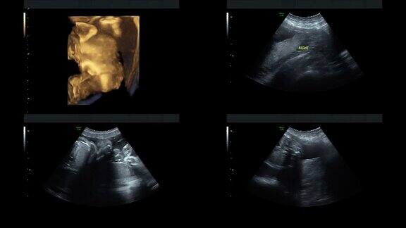 超音波显示同卵双胞胎的心脏在27周时跳动