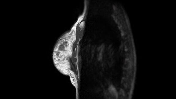 乳腺MRI磁共振成像