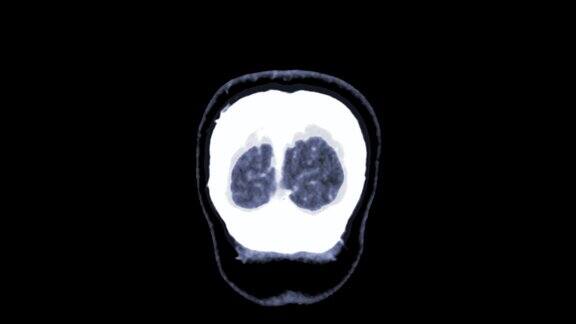脑CTA或ct冠状面3D渲染图像显示人脑血管