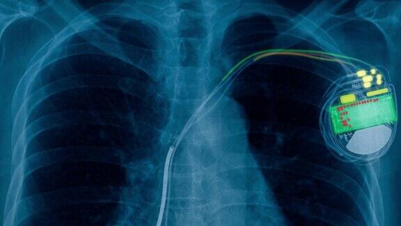 x射线镜头起搏器细胞