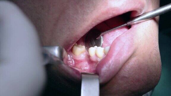 牙科植入物