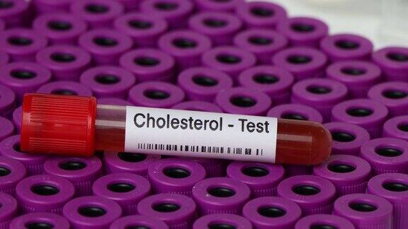 胆固醇测试从血液中寻找异常