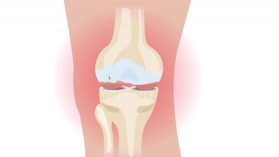 膝骨关节炎