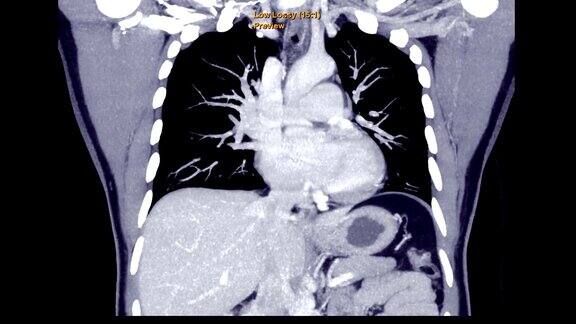 肺栓塞的CTA检查