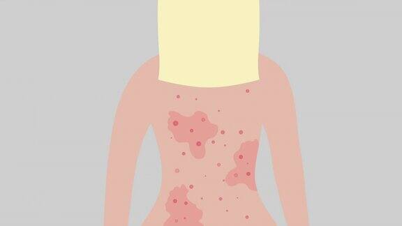 女人背上有粉刺治疗过敏皮肤问题概念