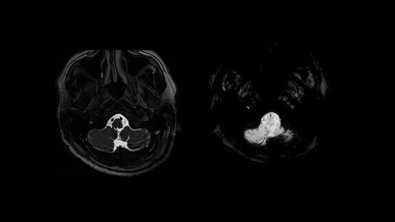 CT脑部核磁共振成像(MRI)