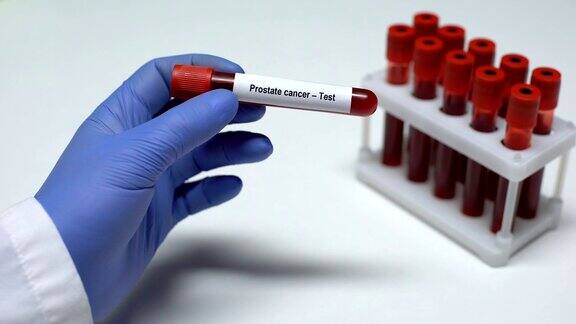 前列腺癌医生在试管中展示血样实验室研究健康检查