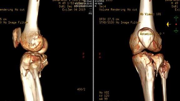 左膝CT扫描图像