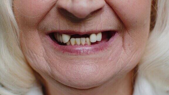 女性老年女性牙齿问题、坏牙脱落的无牙微笑嘴特写宏