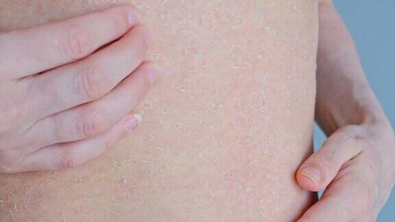 一个女人用指甲抓她腹部的皮肤上面布满了痂皮肤发痒是一个问题皮肤干燥脱皮问题皮肤身体保健特写镜头
