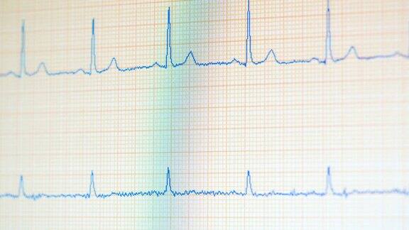 心电图读数变化的医疗监护仪心电监护仪显示心跳正常